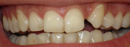 agenesia dentária
